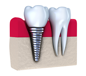 Dental Implants | Dentist In Cary, NC | Karen Torres, DDS, PA
